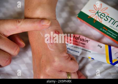 Bilder zeigen einen Patienten, der behandelt wird, nachdem er Mückenstiche während eines Urlaubs in Zante, Griechenland, im Mai 2024 erlitten hat Stockfoto
