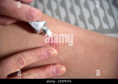 Bilder zeigen einen Patienten, der behandelt wird, nachdem er Mückenstiche während eines Urlaubs in Zante, Griechenland, im Mai 2024 erlitten hat Stockfoto