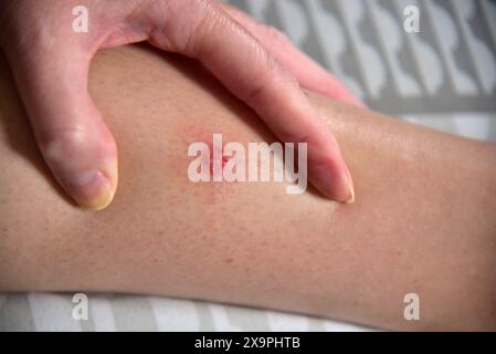 Bilder zeigen einen Patienten, der behandelt wird, nachdem er Mückenstiche während eines Urlaubs in Zante, Griechenland, im Mai 2024 erlitten hat Stockfoto
