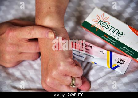Bilder zeigen einen Patienten, der behandelt wird, nachdem er Mückenstiche während eines Urlaubs in Zante, Griechenland, im Mai 2024 erlitten hat Stockfoto