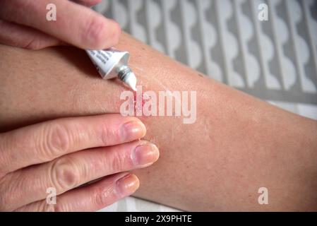 Bilder zeigen einen Patienten, der behandelt wird, nachdem er Mückenstiche während eines Urlaubs in Zante, Griechenland, im Mai 2024 erlitten hat Stockfoto