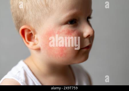 Kleines Kind mit rotem Ausschlag auf der Wange. Stockfoto