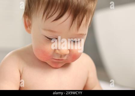 Süßes kleines Baby mit allergischer Rötung auf den Wangen drinnen, Nahaufnahme Stockfoto