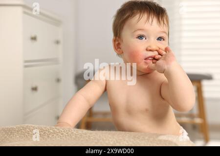 Niedliches kleines Baby mit allergischer Rötung auf den Wangen drinnen Stockfoto