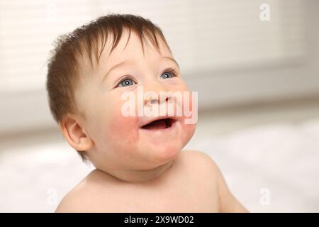 Niedliches kleines Baby mit allergischer Rötung auf den Wangen drinnen Stockfoto