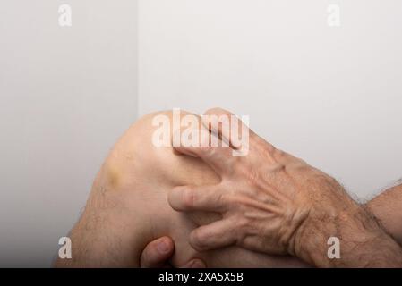 Mann kratzt zwischen Knie und Bein. Hautkrankheiten. Allergische Reaktion. Dermatologie. Isoliert auf weißem Hintergrund. Stockfoto