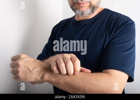 Mann mittleren Alters kratzt sich am Unterarm. Hautkrankheiten. Dermatologische Versorgung Stockfoto