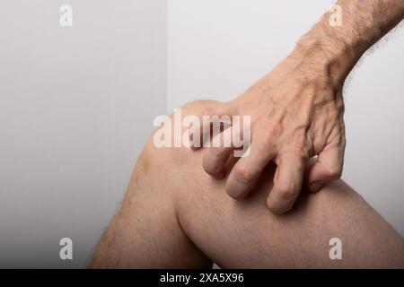 Mann kratzt zwischen Knie und Bein. Hautkrankheiten. Allergische Reaktion. Dermatologie. Isoliert auf weißem Hintergrund. Stockfoto