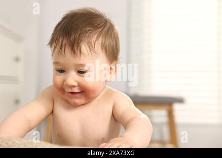 Niedliches kleines Baby mit allergischer Rötung auf den Wangen drinnen Stockfoto