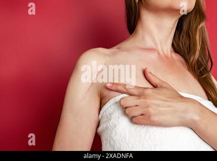 Postoperative Narbe an der Schulter der Frau. Eine Frau zeigt die Narbe. Narbe nach Operation nach gebrochenem Armknochen. Stockfoto