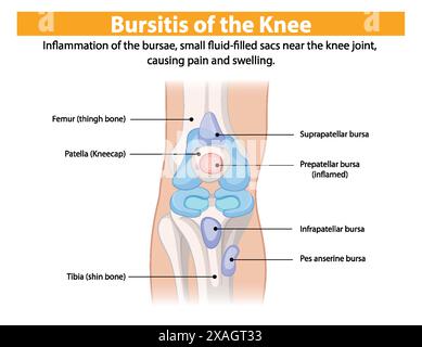 Entzündung der Kniescheibe, die Schmerzen und Schwellungen verursacht Stock Vektor