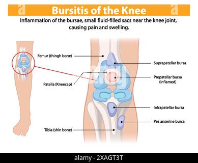 Diagramm mit entzündeter Bursae im Kniegelenk Stock Vektor