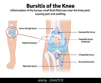 Entzündung der Kniescheibe, die Schmerzen und Schwellungen verursacht Stock Vektor