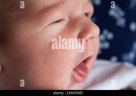 Allergische Pickel bei einem Neugeborenen im Gesicht. Pathogenese, Akne des Neugeborenen, Nahaufnahme Stockfoto