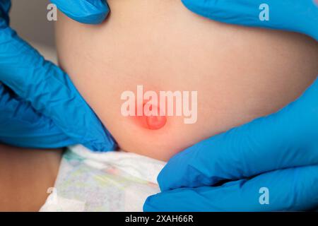 Arzthände in medizinischen Handschuhen untersuchen den Nabelring eines Neugeborenen. Die Behandlung der Nabelhernie im Kindesalter. Stockfoto