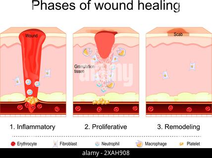 Wundheilungsvorgang. Gewebereparatur. Entzündliche, proliferative, Remodeling-Phase. Querschnitt menschlicher Haut nach Trauma. Unterbrechung und Beschädigung o Stock Vektor