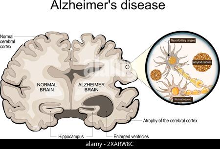 Alzheimer-Krankheit. Neurodegeneration. Querschnitt von normalem und Alzheimer-Gehirn mit Atrophie der Großhirnrinde, vergrößerten Ventrikeln und Hipp Stock Vektor