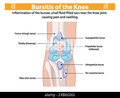 Entzündung der Kniescheibe, die Schmerzen und Schwellungen verursacht Stock Vektor