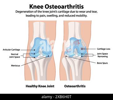 Gesundes Kniegelenk vs. Osteoarthritis Kniegelenk Stock Vektor