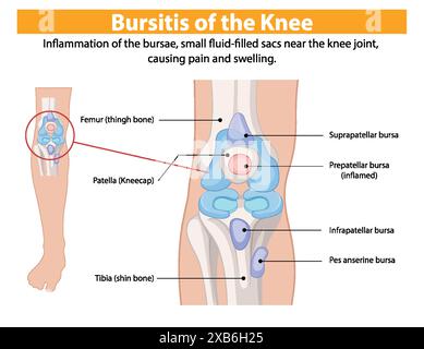 Diagramm mit entzündeten Kniescheiben und Knochen Stock Vektor