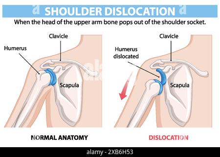 Vergleich normaler und luxationaler Schulteranatomie Stock Vektor