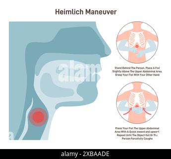 Ersticken erste Hilfe. Heimlich-Manöver-Verfahren zur Entfernung eines Fremdkörpers aus den Atemwegen des Menschen. Anleitung zur Handplatzierung. Illustration des flachen Vektors Stock Vektor