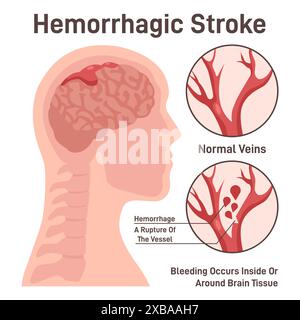 Das Konzept des hämorrhagischen Hirnschlags. Hirnblutung, Blutgefässruptur. Schlaganfall und Koronarerkrankung, Blutungen im menschlichen Kopf. Medizinische Notfallversorgung. Illustration des flachen Vektors Stock Vektor