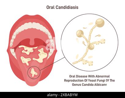 Orale Candidiasis. Orale Hefeinfektion von Candida albicans Pilzpilzen an den Mundschleimhäuten. Mundhöhle, Mundkrankheitssymptom. Illustration des flachen Vektors Stock Vektor