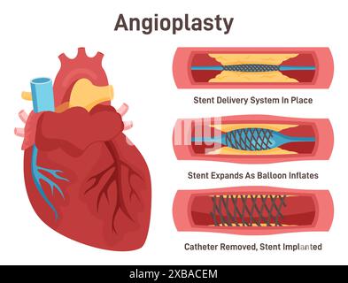 Angioplastie. Stentlieferung und Implantation. Ein in eine Koronararterie eingeführter, entlüfteter Ballonkatheter. Stent, der eine Blutgefässwand ausdehnt. Illustration des flachen Vektors Stock Vektor