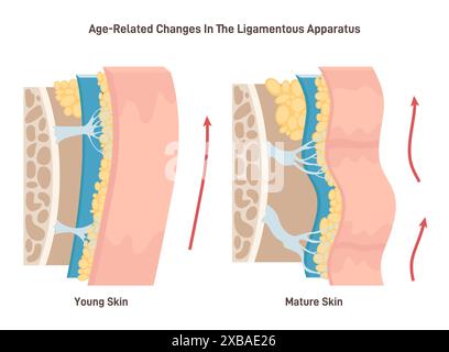 Alterungsprozess und Gesichtsbandlockerung. Nahhautstruktur mit Elastizitätsverlust an den Epidermisschichten. Ursache der Faltenbildung. Illustration des flachen Vektors Stock Vektor