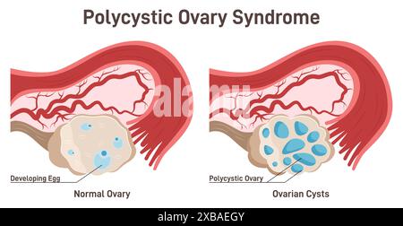 Polyzystisches Ovarialsyndrom. PCOS-Hormonerkrankung. Das weibliche Fortpflanzungssystem. Uterus, Zervix, Ovar und Eileiter. Querschnittsdiagramm, Untersuchung des Fortpflanzungssystems. Illustration des flachen Vektors Stock Vektor