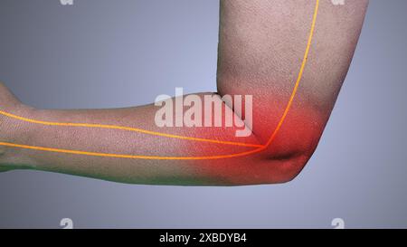 Das medizinische Konzept des Kubitaltunnelsyndroms Stockfoto