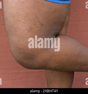 Ekzem auf brauner Haut, atopische Dermatitis und Prurigo nodularis auf brauner Haut am Bein, Ekzemausbruch auf dunkler Haut Stockfoto