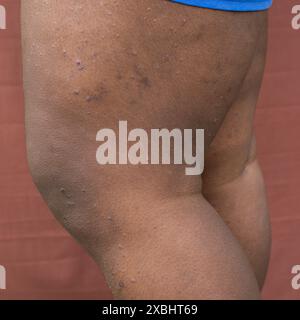 Ekzem auf brauner Haut, atopische Dermatitis und Prurigo nodularis auf brauner Haut am Bein, Ekzemausbruch auf dunkler Haut Stockfoto