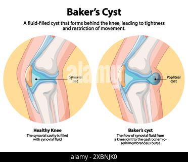 Vergleich von gesundem Knie und Baker-Zyste Stock Vektor