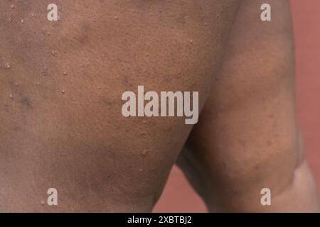 Ekzem auf brauner Haut, atopische Dermatitis und Prurigo nodularis auf brauner Haut am Bein, Ekzemausbruch auf dunkler Haut Stockfoto