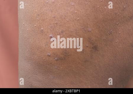 Ekzem auf brauner Haut, atopische Dermatitis und Prurigo nodularis auf brauner Haut am Bein, Ekzemausbruch auf dunkler Haut Stockfoto