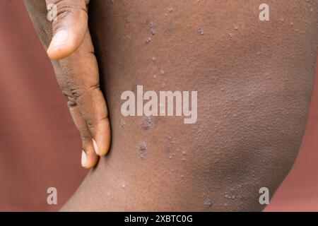 Ekzem auf brauner Haut, atopische Dermatitis und Prurigo nodularis auf brauner Haut am Bein, Ekzemausbruch auf dunkler Haut Stockfoto