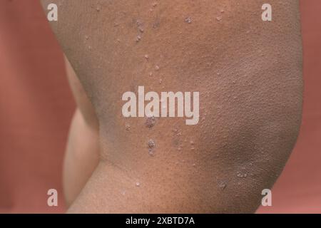 Ekzem auf brauner Haut, atopische Dermatitis und Prurigo nodularis auf brauner Haut am Bein, Ekzemausbruch auf dunkler Haut Stockfoto