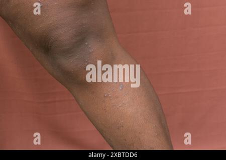 Ekzem auf brauner Haut, atopische Dermatitis und Prurigo nodularis auf brauner Haut am Bein, Ekzemausbruch auf dunkler Haut Stockfoto