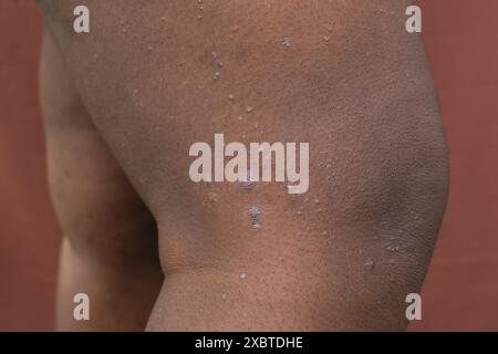 Ekzem auf brauner Haut, atopische Dermatitis und Prurigo nodularis auf brauner Haut am Bein, Ekzemausbruch auf dunkler Haut Stockfoto