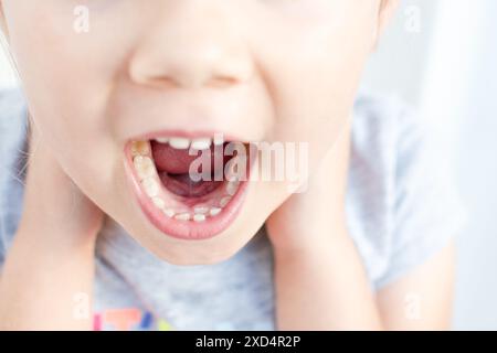 Erwachsene permanente Zähne vor den Säuglingszähnen: Haizähne. Der Mund des kleinen Mädchens ist offen. Stockfoto