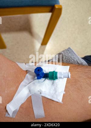 Deutschland - 20. Juni 2024: Arm mit intravenöser Kanüle Venflon an Ort und Stelle. Die Kanüle wird mit Klebeband oder Pflaster fixiert und dient als Zugang für Infusionen oder Blutentnahmen. Patient oder Person in einer medizinischen Einrichtung in einem Krankenhaus oder in der Chirurgie eines Arztes vor einer Operation. *** Arm, mit intravenösen Kanüle Venflon gelegt. Die Kanüle ist mit Klebeband bzw. Pflaster fixiert und dient dem Zugang für Infusionen oder Blutentnahmen. Patient, bzw. Person in einer medizinischen Einrichtung in einem Krankenhaus bzw. Arztpraxis vor einer Operation. Stockfoto