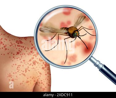 Mückenbiss und Mücken Bissen Risiko Ormosquitos im Freien übertragen schädliche Infektionen, während Malaria und Virus sich verbreiten. Stockfoto