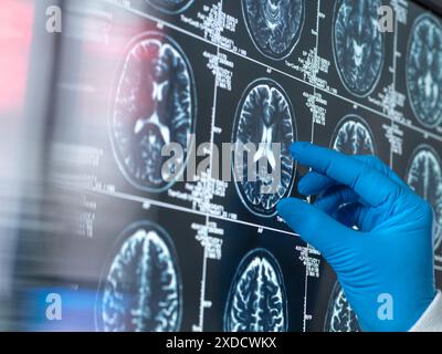 Wissenschaftler, die eine MRT (Magnetresonanztomographie) des Gehirns eines Patienten auf Alterung und Schäden durch Demenz und Alzheimer-Krankheit untersuchen. Stockfoto