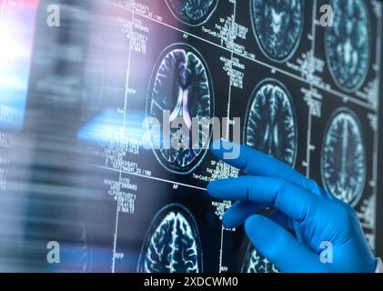 Wissenschaftler, die eine MRT (Magnetresonanztomographie) des Gehirns eines Patienten auf Alterung und Schäden durch Demenz und Alzheimer-Krankheit untersuchen. Stockfoto