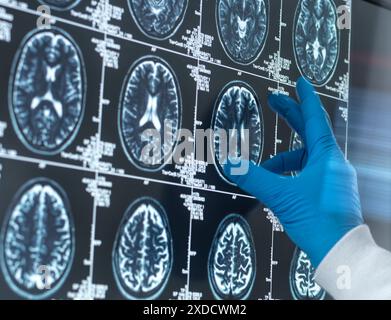 Wissenschaftler, die eine MRT (Magnetresonanztomographie) des Gehirns eines Patienten auf Alterung und Schäden durch Demenz und Alzheimer-Krankheit untersuchen. Stockfoto
