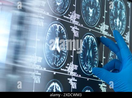 Wissenschaftler, die eine MRT (Magnetresonanztomographie) des Gehirns eines Patienten auf Alterung und Schäden durch Demenz und Alzheimer-Krankheit untersuchen. Stockfoto