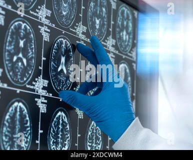 Wissenschaftler, die eine MRT (Magnetresonanztomographie) des Gehirns eines Patienten auf Alterung und Schäden durch Demenz und Alzheimer-Krankheit untersuchen. Stockfoto