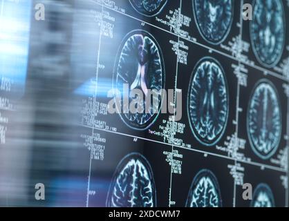 Wissenschaftler, die eine MRT (Magnetresonanztomographie) des Gehirns eines Patienten auf Alterung und Schäden durch Demenz und Alzheimer-Krankheit untersuchen. Stockfoto